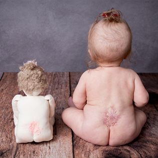 Neurogenic bladder from spinal cord lesions, such as myelomeningocele